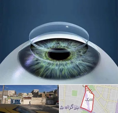 پیوند قرنیه در اتابک