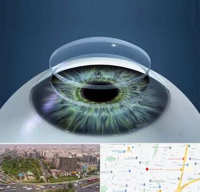 پیوند قرنیه در آیت الله کاشانی