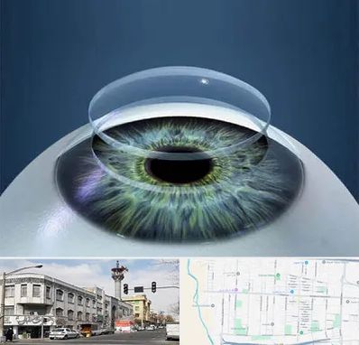 پیوند قرنیه در 17شهریور