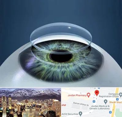 پیوند قرنیه در جردن 