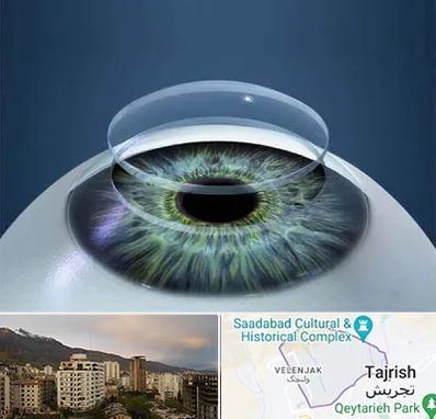 پیوند قرنیه در زعفرانیه 