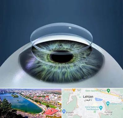 پیوند قرنیه در لاهیجان