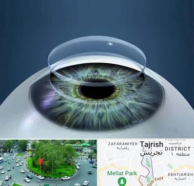 پیوند قرنیه در تجریش 