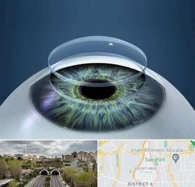 پیوند قرنیه در یوسف آباد 