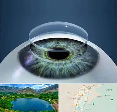 پیوند قرنیه در رودبار