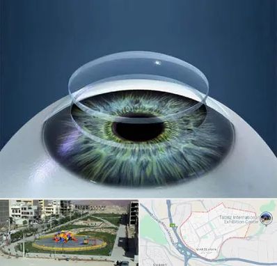 پیوند قرنیه در مرزداران تبریز