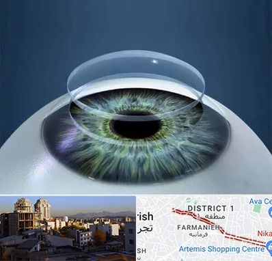 پیوند قرنیه در فرمانیه 