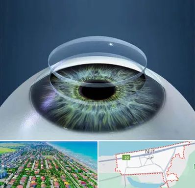 پیوند قرنیه در نور