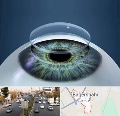 پیوند قرنیه در باقرشهر