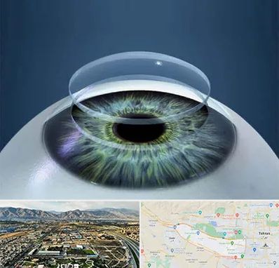 پیوند قرنیه در منطقه 21 تهران 