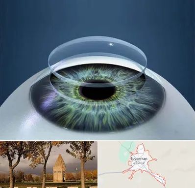 پیوند قرنیه در تویسرکان