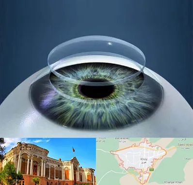 پیوند قرنیه در خوی