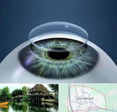 پیوند قرنیه در صومعه سرا