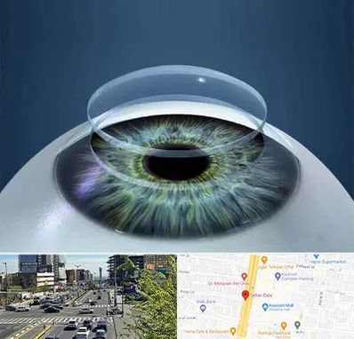 پیوند قرنیه در ستاری 