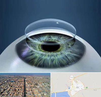 پیوند قرنیه در بندر ماهشهر