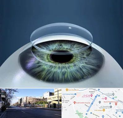 پیوند قرنیه در خیابان ملاصدرا شیراز