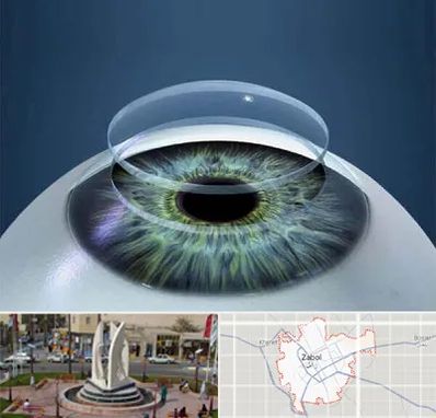 پیوند قرنیه در زابل