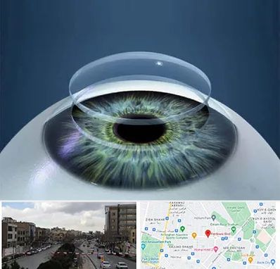 پیوند قرنیه در بلوار فردوسی مشهد 