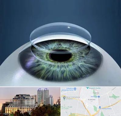 پیوند قرنیه در فرشته 