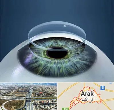 پیوند قرنیه در اراک