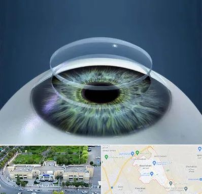 پیوند قرنیه در نسیم شهر