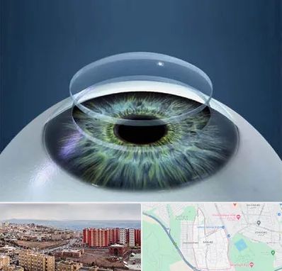 پیوند قرنیه در سهند تبریز