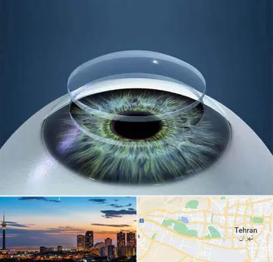 پیوند قرنیه در غرب تهران 