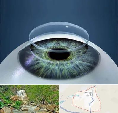 پیوند قرنیه در کردان