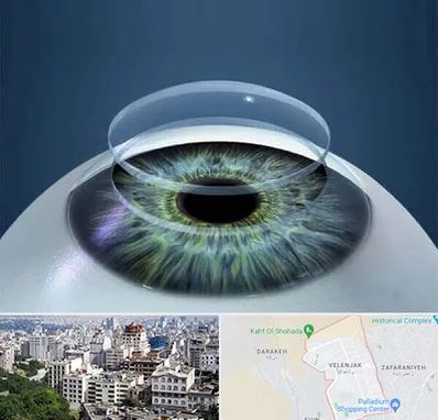 پیوند قرنیه در ولنجک 