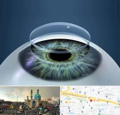 پیوند قرنیه در رسالت 