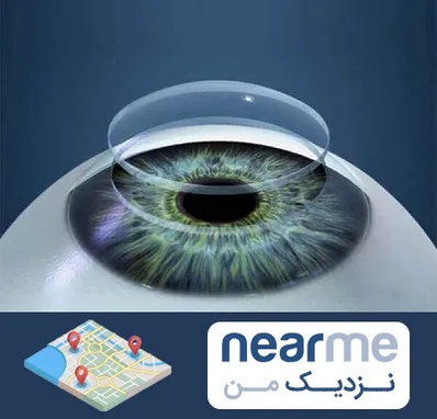 پیوند قرنیه در نزدیک من