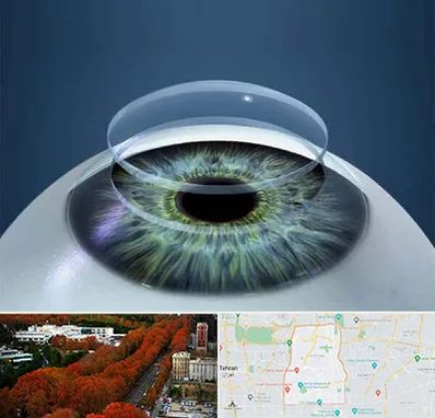 پیوند قرنیه در منطقه 6 تهران 