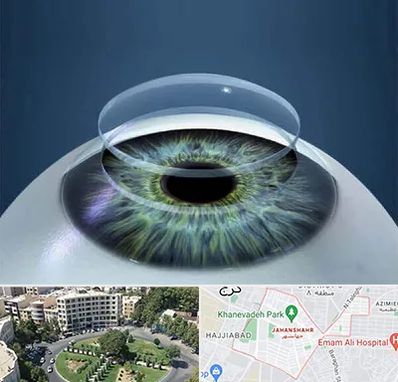 پیوند قرنیه در جهانشهر کرج 