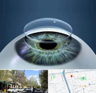 پیوند قرنیه در کوی فیروز تبریز