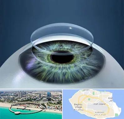 پیوند قرنیه در کیش