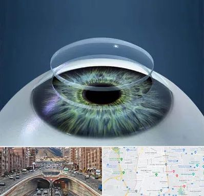 پیوند قرنیه در منطقه 10 تهران 