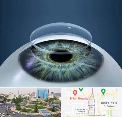 پیوند قرنیه در ونک 