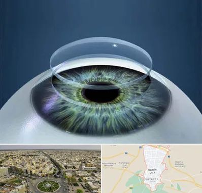 پیوند قرنیه در قزوین