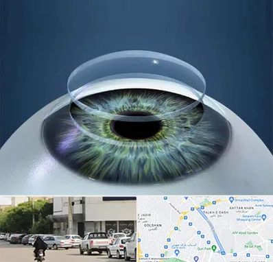 پیوند قرنیه در قدوسی شرقی شیراز