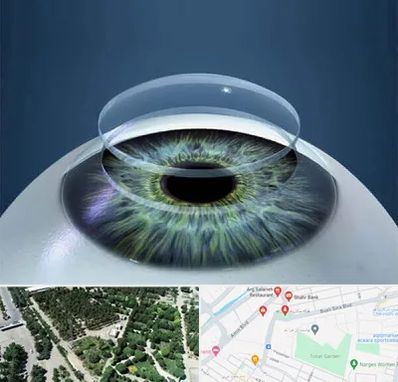 پیوند قرنیه در سالاریه قم