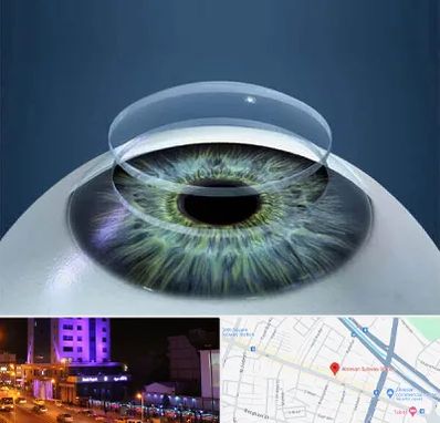 پیوند قرنیه در آبرسان تبریز