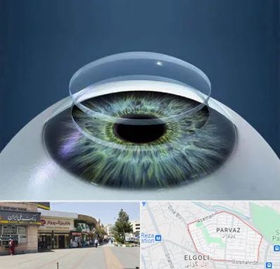 پیوند قرنیه در پرواز تبریز