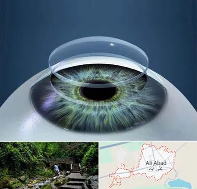 پیوند قرنیه در علی آباد کتول