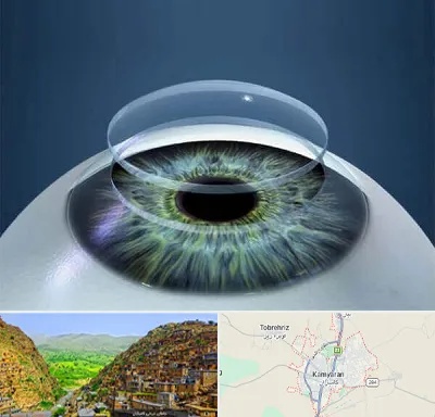 پیوند قرنیه در کامیاران