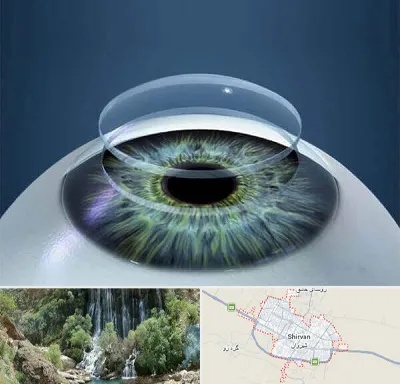 پیوند قرنیه در شیروان