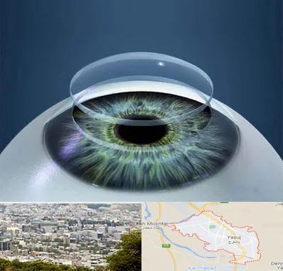 پیوند قرنیه در یاسوج