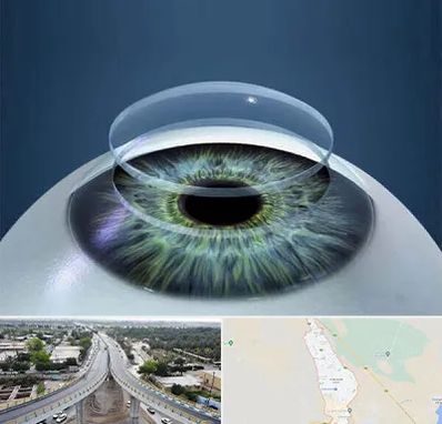 پیوند قرنیه در اندیمشک