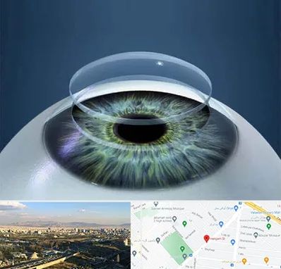 پیوند قرنیه در هنگام 