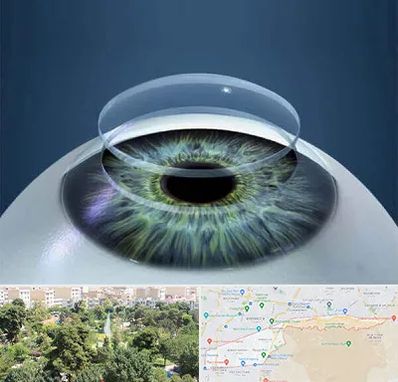 پیوند قرنیه در منطقه 13 تهران 