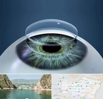 پیوند قرنیه در ایلام
